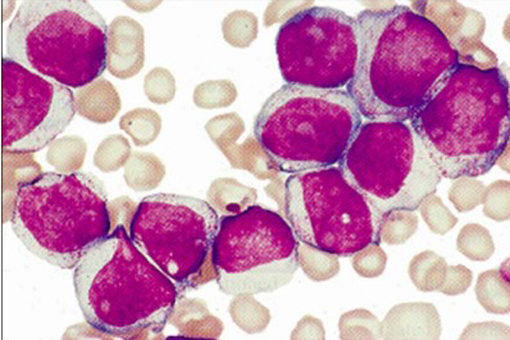 LA LEUCEMIA MIELOIDE ACUTA E I CONTINUI PROGRESSI DELLA RICERCA SUL FRONTE DELLE MALATTIE DEL SANGUE