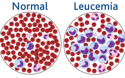 LEUCEMIA LINFOBLASTICA ACUTA E LE POSSIBILI TERAPIE