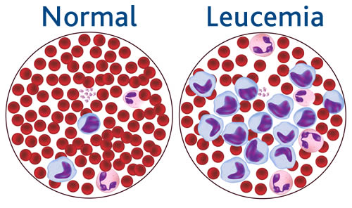 LEUCEMIA LINFOBLASTICA ACUTA E LE POSSIBILI TERAPIE